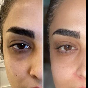 Dark circle treatment before and after by Dr. Rubab