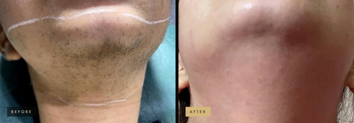 Laser hair removal on the chin and neck before and after