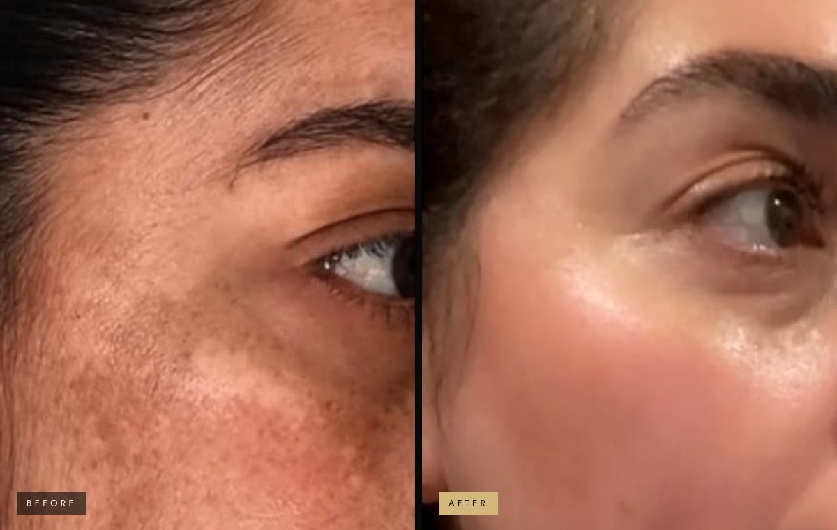 Melasma and pigmentation before and after