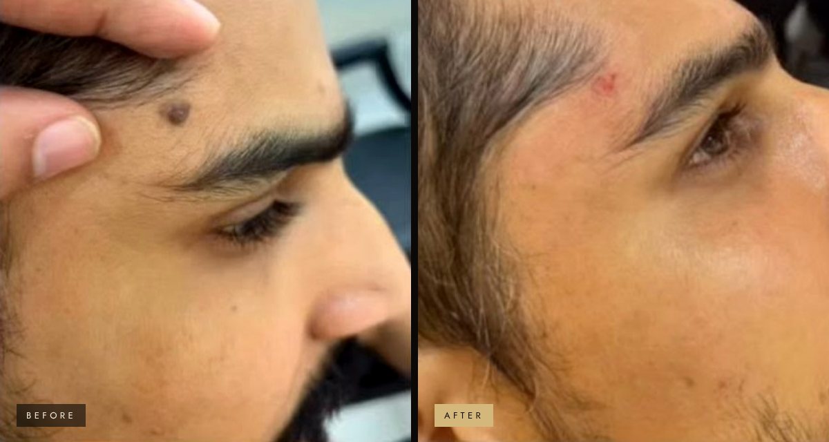Mole removal on the forehead before and after