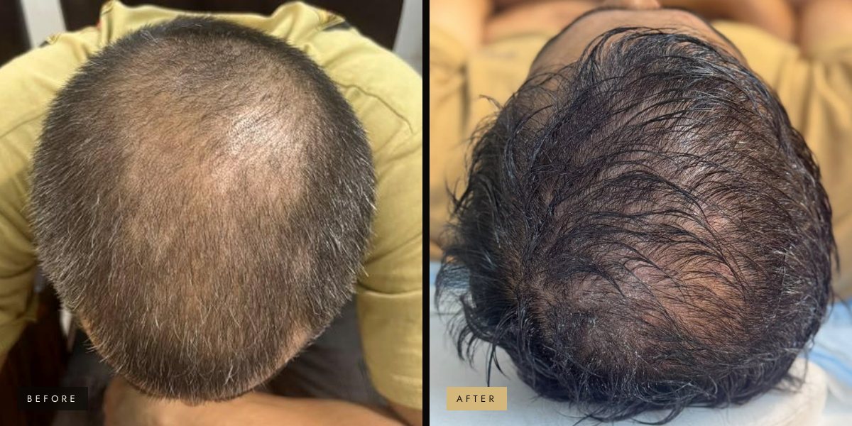 PRP hair therapy, after 3–4 sessions before and after